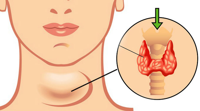 نشانه های کمبود ید و تورم در گردن
